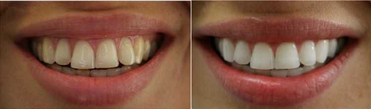 Home Teeth Whitening System