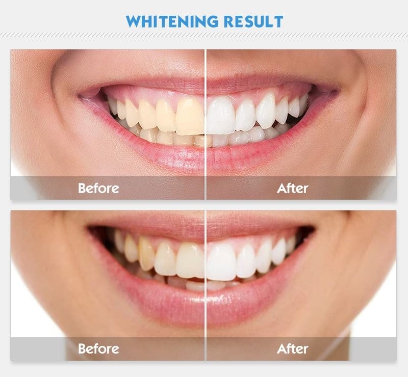 Cold Light Dental Teeth Whitening Machine