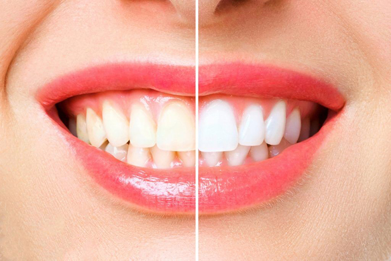 Why Do Teeth Turn Yellow Quickly After Whitening? Remember These 3 Daily Habits!