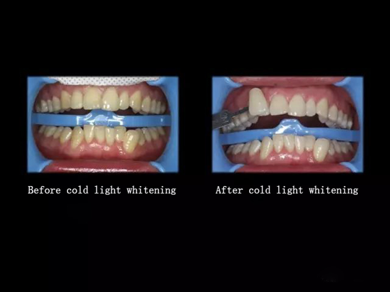 How Do Cold Light Teeth Whitening?