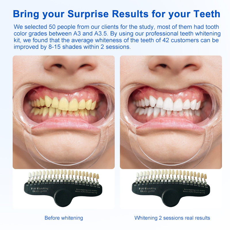 Max 5 Teeth Whitening Kit for Dental Clinic