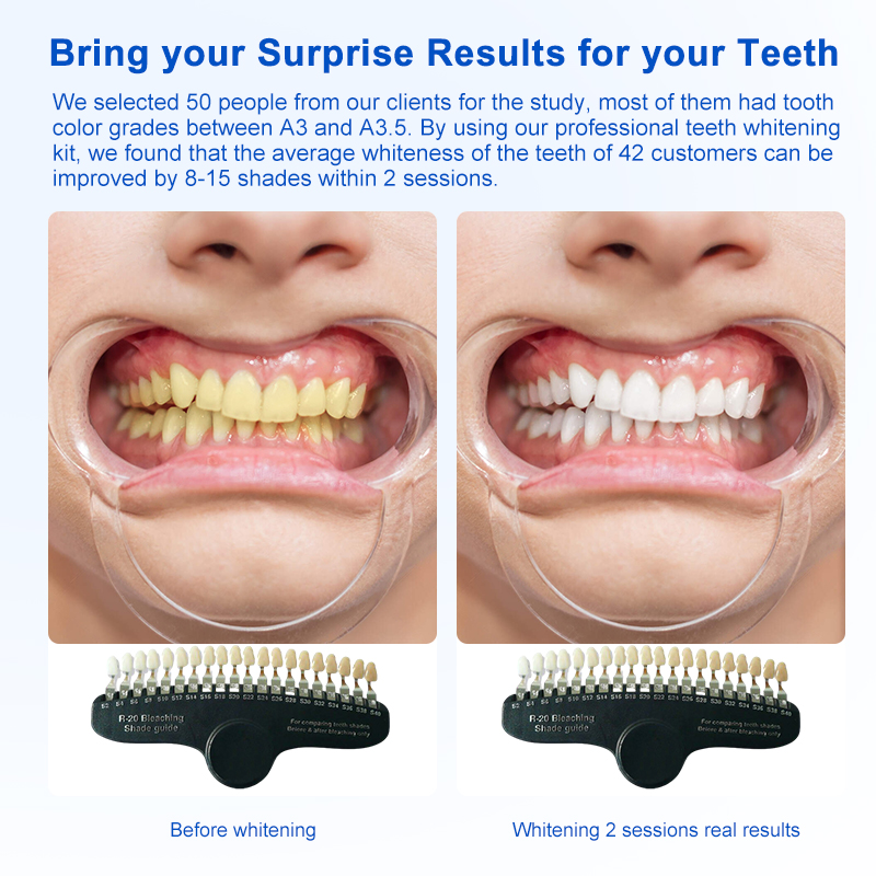 Two Patients Use Professional Teeth Whitening Gel Kit Used by Clinic Dentist