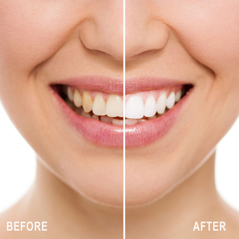 Dissolving Teeth Whitening Strips