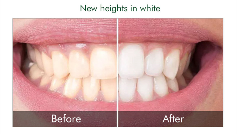 0.1-44%CP Teeth Whitening Gel Kit OEM