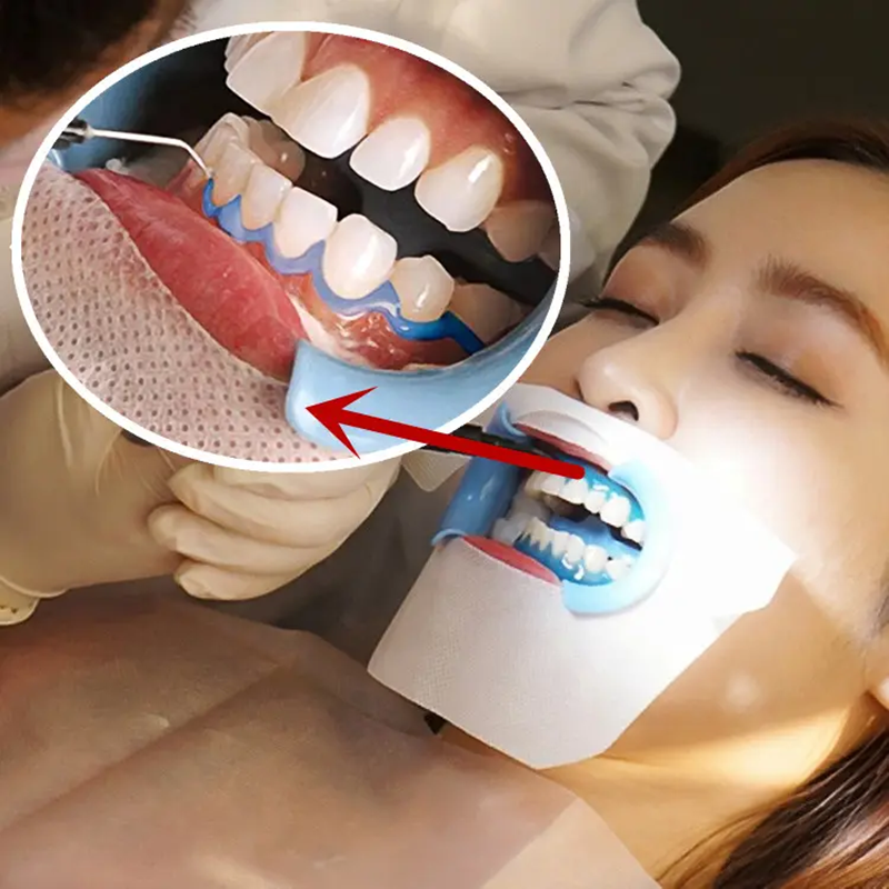 Deluxe Dentist 35% HP Teeth Whitening Kit For Dental Clinic