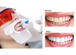 Fast Teeth Whitening for my customers