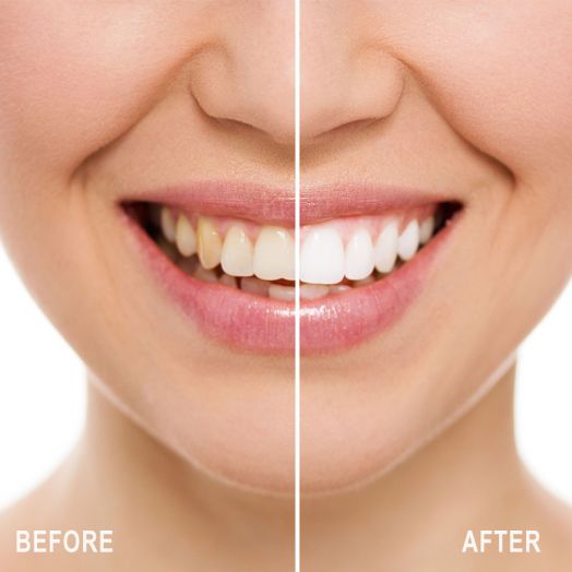 Dissolving Teeth Whitening Strips - More Convenient & Comfortable