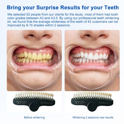 Luxury Dentist Uses 35% HP Professional Teeth Whitening Kit for One Person